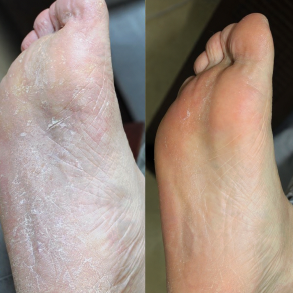 Foot before and after comparison 2