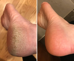 Foot-care customer comparison 3