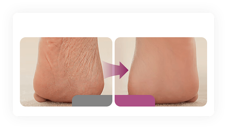 Foot care