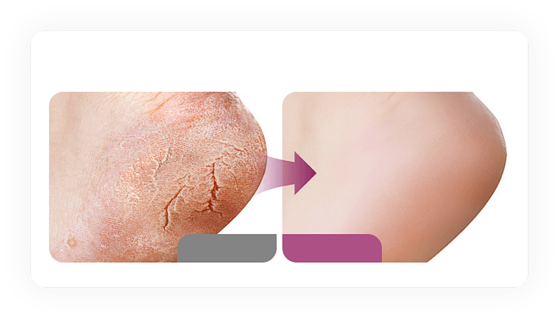 Dry, cracked skin