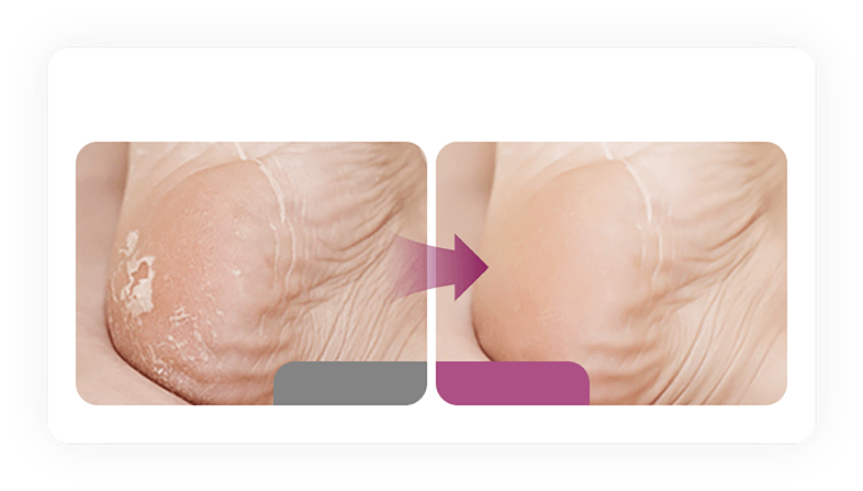 Dead skin